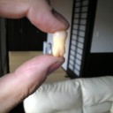 親知らずまた抜きました