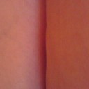 sunburn/suntan ’09