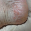 群発膿胞。（～～；）
