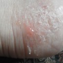 朝の被曝足。