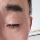 右目まぶたはオデキ！？